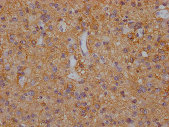 IHC image of CSB-PA021434LA11HU diluted at 1:200 and staining in paraffin-embedded human glioma cancer performed on a Leica BondTM system. After dewaxing and hydration, antigen retrieval was mediated by high pressure in a citrate buffer (pH 6.0)....