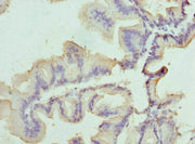 Immunohistochemistry of paraffin-embedded human prostate cancer using CSB-PA021488ESR1HU at dilution of 1:100