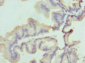 Immunohistochemistry of paraffin-embedded human prostate cancer using CSB-PA021488ESR1HU at dilution of 1:100