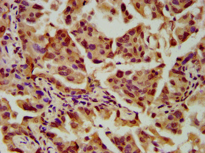 IHC image of CSB-PA021558LA01HU diluted at 1:600 and staining in paraffin-embedded human lung cancer performed on a Leica BondTM system. After dewaxing and hydration, antigen retrieval was mediated by high pressure in a citrate buffer (pH 6.0). Se...