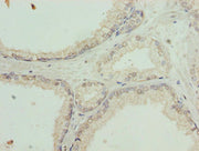 Immunohistochemistry of paraffin-embedded human prostate cancer using CSB-PA021577LA01HU at dilution of 1:100