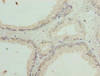 Immunohistochemistry of paraffin-embedded human prostate cancer using CSB-PA021577LA01HU at dilution of 1:100