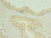 Immunohistochemistry of paraffin-embedded human prostate cancer using CSB-PA021581LA01HU at dilution of 1:100