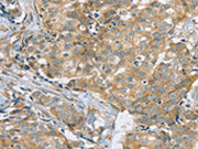 The image on the left is immunohistochemistry of paraffin-embedded Human breast cancer tissue using CSB-PA021593(SLC9A3R2 Antibody) at dilution 1/25, on the right is treated with synthetic peptide. (Original magnification: ×200)