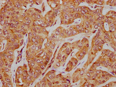 IHC image of CSB-PA021596LA01HU diluted at 1:500 and staining in paraffin-embedded human liver cancer performed on a Leica BondTM system. After dewaxing and hydration, antigen retrieval was mediated by high pressure in a citrate buffer (pH 6.0). S...