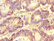 Immunohistochemistry of paraffin-embedded human colon cancer using CSB-PA021610LA01HU at dilution of 1:100