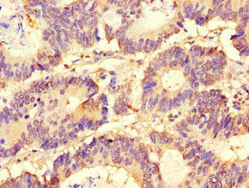 Immunohistochemistry of paraffin-embedded human colon cancer using CSB-PA021610LA01HU at dilution of 1:100