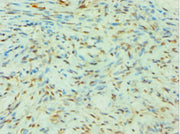 Immunohistochemistry of paraffin-embedded human breast cancer using CSB-PA021667DSR2HU at dilution of 1:100