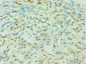 Immunohistochemistry of paraffin-embedded human breast cancer using CSB-PA021667DSR2HU at dilution of 1:100