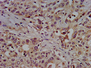 IHC image of CSB-PA021709LA01HU diluted at 1:500 and staining in paraffin-embedded human liver cancer performed on a Leica BondTM system. After dewaxing and hydration, antigen retrieval was mediated by high pressure in a citrate buffer (pH 6.0). S...