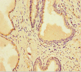 Immunohistochemistry of paraffin-embedded human prostate cancer using CSB-PA021798LA01HU at dilution of 1:100