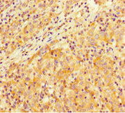 Immunohistochemistry of paraffin-embedded human lung cancer using CSB-PA021801LA01HU at dilution of 1:100