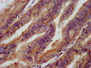 IHC image of CSB-PA021846LA01HU diluted at 1:200 and staining in paraffin-embedded human endometrial cancer performed on a Leica BondTM system. After dewaxing and hydration, antigen retrieval was mediated by high pressure in a citrate buffer (pH 6...