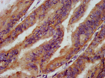 IHC image of CSB-PA021846LA01HU diluted at 1:200 and staining in paraffin-embedded human endometrial cancer performed on a Leica BondTM system. After dewaxing and hydration, antigen retrieval was mediated by high pressure in a citrate buffer (pH 6...