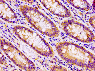 IHC image of CSB-PA021871LA01HU diluted at 1:100 and staining in paraffin-embedded human colon cancer performed on a Leica BondTM system. After dewaxing and hydration, antigen retrieval was mediated by high pressure in a citrate buffer (pH 6.0). S...