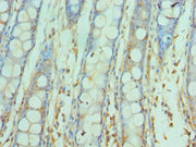 Immunohistochemistry of paraffin-embedded human colon cancer using CSB-PA021873ESR1HU at dilution of 1:100