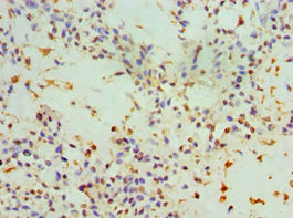 Immunohistochemistry of paraffin-embedded human breast cancer using CSB-PA021912DSR1HU at dilution of 1:100