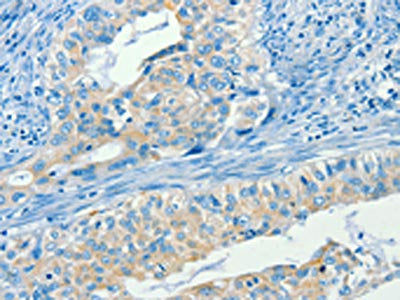 The image on the left is immunohistochemistry of paraffin-embedded Human cervical cancer tissue using CSB-PA022029(SERPINA9 Antibody) at dilution 1/60, on the right is treated with synthetic peptide. (Original magnification: ×200)