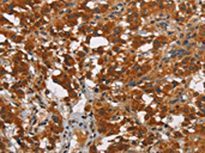 The image on the left is immunohistochemistry of paraffin-embedded Human thyroid cancer tissue using CSB-PA022161(SMAD9 Antibody) at dilution 1/40, on the right is treated with synthetic peptide. (Original magnification: ×200)