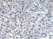 The image on the left is immunohistochemistry of paraffin-embedded Human liver cancer tissue using CSB-PA022208(CLDN19 Antibody) at dilution 1/30, on the right is treated with synthetic peptide. (Original magnification: ×200)