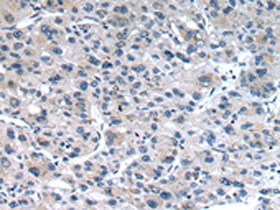 The image on the left is immunohistochemistry of paraffin-embedded Human liver cancer tissue using CSB-PA022208(CLDN19 Antibody) at dilution 1/30, on the right is treated with synthetic peptide. (Original magnification: ×200)