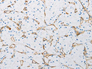 The image on the left is immunohistochemistry of paraffin-embedded Human renal cancer tissue using CSB-PA022257(PECAM1 Antibody) at dilution 1/25, on the right is treated with synthetic peptide. (Original magnification: ×200)