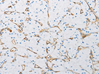 The image on the left is immunohistochemistry of paraffin-embedded Human renal cancer tissue using CSB-PA022257(PECAM1 Antibody) at dilution 1/25, on the right is treated with synthetic peptide. (Original magnification: ×200)