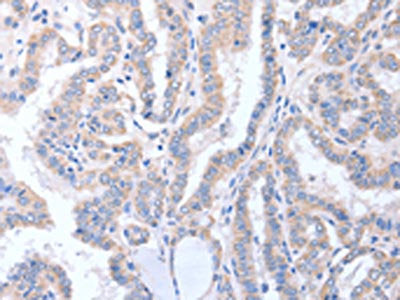 The image on the left is immunohistochemistry of paraffin-embedded Human thyroid cancer tissue using CSB-PA022273(ACTL8 Antibody) at dilution 1/15, on the right is treated with fusion protein. (Original magnification: ×200)