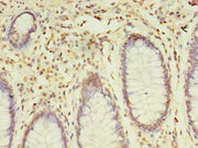 Immunohistochemistry of paraffin-embedded human colon cancer using CSB-PA022369HA01HU at dilution of 1:100
