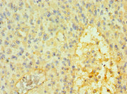 Immunohistochemistry of paraffin-embedded human glioma using CSB-PA022422ESR1HU at dilution of 1:100