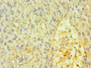 Immunohistochemistry of paraffin-embedded human glioma using CSB-PA022422ESR1HU at dilution of 1:100