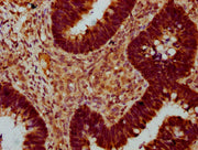 IHC image of CSB-PA022430LA01HU diluted at 1:400 and staining in paraffin-embedded human ovarian cancer performed on a Leica BondTM system. After dewaxing and hydration, antigen retrieval was mediated by high pressure in a citrate buffer (pH 6.0)....
