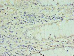Immunohistochemistry of paraffin-embedded human colon cancer using CSB-PA022434DSR2HU at dilution of 1:100