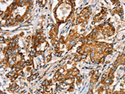 The image on the left is immunohistochemistry of paraffin-embedded Human liver cancer tissue using CSB-PA022560(SLC5A11 Antibody) at dilution 1/35, on the right is treated with synthetic peptide. (Original magnification: ×200)