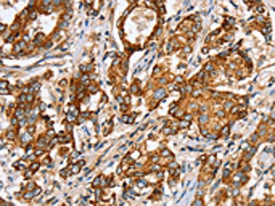 The image on the left is immunohistochemistry of paraffin-embedded Human liver cancer tissue using CSB-PA022560(SLC5A11 Antibody) at dilution 1/35, on the right is treated with synthetic peptide. (Original magnification: ×200)