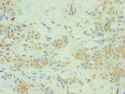 Immunohistochemistry of paraffin-embedded human breast cancer using CSB-PA022584ESR1HU at dilution of 1:100