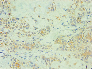 Immunohistochemistry of paraffin-embedded human breast cancer using CSB-PA022584ESR1HU at dilution of 1:100