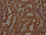 IHC image of CSB-PA022650LA11HU diluted at 1:200 and staining in paraffin-embedded human breast cancer performed on a Leica BondTM system. After dewaxing and hydration, antigen retrieval was mediated by high pressure in a citrate buffer (pH 6.0)....