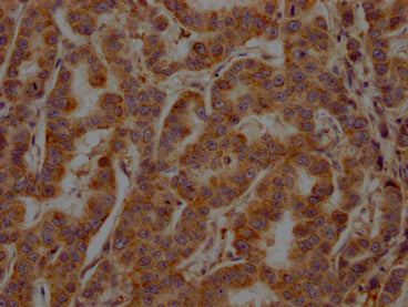 IHC image of CSB-PA022650LA11HU diluted at 1:200 and staining in paraffin-embedded human breast cancer performed on a Leica BondTM system. After dewaxing and hydration, antigen retrieval was mediated by high pressure in a citrate buffer (pH 6.0)....