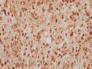 IHC image of CSB-PA022683LA01HU diluted at 1:100 and staining in paraffin-embedded human glioma cancer performed on a Leica BondTM system. After dewaxing and hydration, antigen retrieval was mediated by high pressure in a citrate buffer (pH 6.0)....