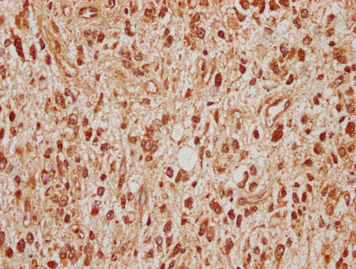 IHC image of CSB-PA022683LA01HU diluted at 1:100 and staining in paraffin-embedded human glioma cancer performed on a Leica BondTM system. After dewaxing and hydration, antigen retrieval was mediated by high pressure in a citrate buffer (pH 6.0)....