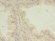 Immunohistochemistry of paraffin-embedded human prostate cancer using CSB-PA022710LA01HU at dilution of 1:100