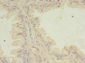 Immunohistochemistry of paraffin-embedded human prostate cancer using CSB-PA022710LA01HU at dilution of 1:100