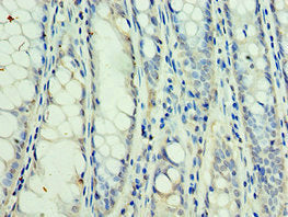 Immunohistochemistry of paraffin-embedded human colon cancer using CSB-PA022714ESR1HU at dilution of 1:100