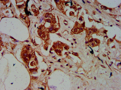 IHC image of CSB-PA022718LA01HU diluted at 1:500 and staining in paraffin-embedded human breast cancer performed on a Leica BondTM system. After dewaxing and hydration, antigen retrieval was mediated by high pressure in a citrate buffer (pH 6.0)....