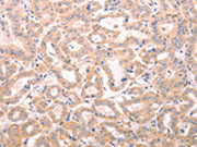 The image on the left is immunohistochemistry of paraffin-embedded Human thyroid cancer tissue using CSB-PA022733(ABHD12 Antibody) at dilution 1/25, on the right is treated with fusion protein. (Original magnification: ×200)