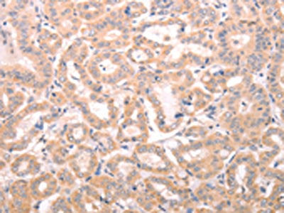 The image on the left is immunohistochemistry of paraffin-embedded Human thyroid cancer tissue using CSB-PA022733(ABHD12 Antibody) at dilution 1/25, on the right is treated with fusion protein. (Original magnification: ×200)