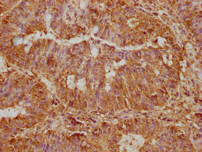 IHC image of CSB-PA022758LA01HU diluted at 1:500 and staining in paraffin-embedded human colon cancer performed on a Leica BondTM system. After dewaxing and hydration, antigen retrieval was mediated by high pressure in a citrate buffer (pH 6.0). S...