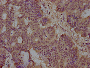 IHC image of CSB-PA022758NA01HU diluted at 1:100 and staining in paraffin-embedded human colon cancer performed on a Leica BondTM system. After dewaxing and hydration, antigen retrieval was mediated by high pressure in a citrate buffer (pH 6.0). S...