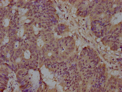 IHC image of CSB-PA022758NA01HU diluted at 1:100 and staining in paraffin-embedded human colon cancer performed on a Leica BondTM system. After dewaxing and hydration, antigen retrieval was mediated by high pressure in a citrate buffer (pH 6.0). S...